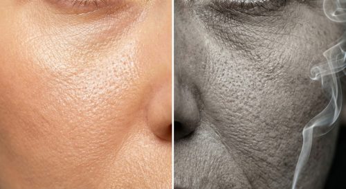 Курение разрушает коллагеновые волокна кожи и ускоряет преждевременное старение лица